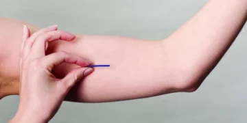 Novo implante contraceptivo chega ao SUS ainda este ano