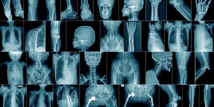 Cientistas soam o alarme após descoberta perturbadora em ossos humanos