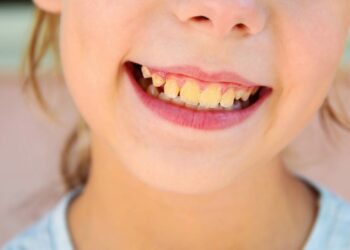 Achava que era descuido? Veja por que seus dentes podem ficar amarelos mesmo com higiene impecável