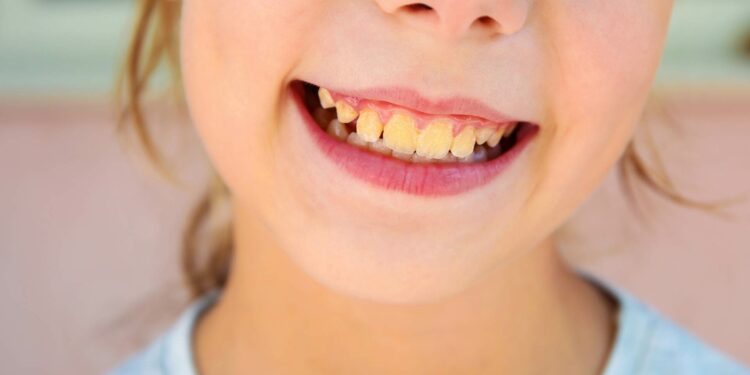 Achava que era descuido? Veja por que seus dentes podem ficar amarelos mesmo com higiene impecável