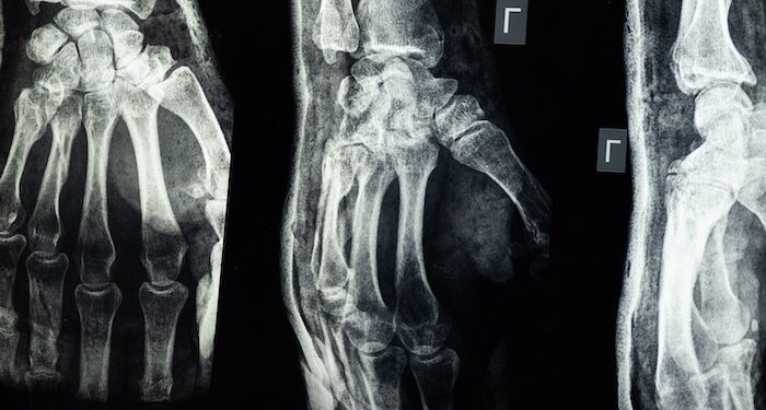 O segredo para ossos sem dor: a vitamina que todos deveriam tomar