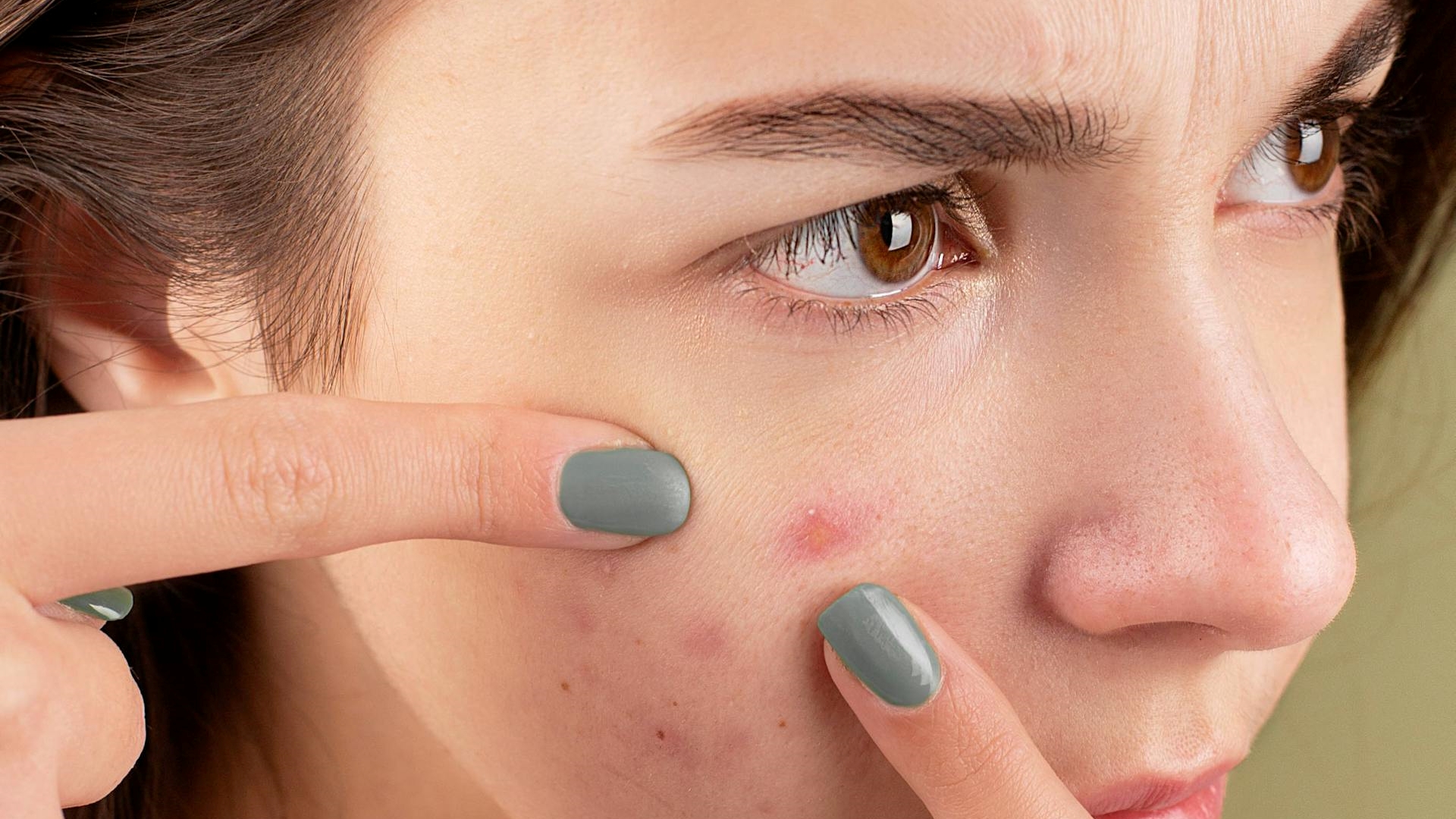Adeus, acne! Cientistas desenvolvem vacina que promete eliminar espinhas