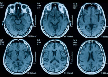 Doença grave atinge o cérebro e é responsável pela morte de um brasileiro a cada 6 minutos