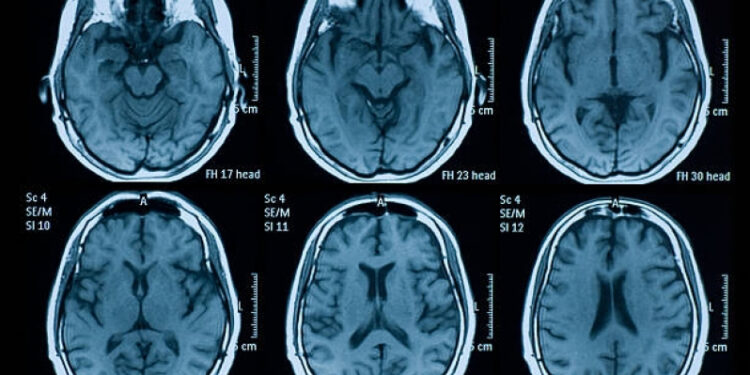 Doença grave atinge o cérebro e é responsável pela morte de um brasileiro a cada 6 minutos