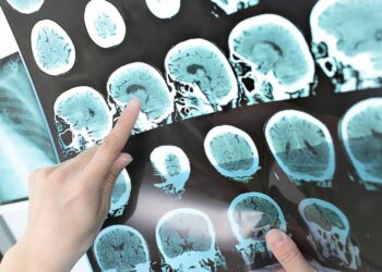 Cientistas interrompem avanço do Alzheimer: o que eles descobriram vai mudar tudo