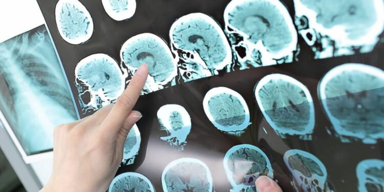 Cientistas interrompem avanço do Alzheimer: o que eles descobriram vai mudar tudo