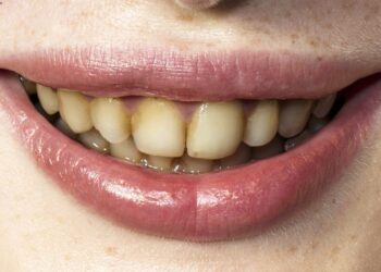 Os vilões da higiene dental: alimentos que escurecem os dentes