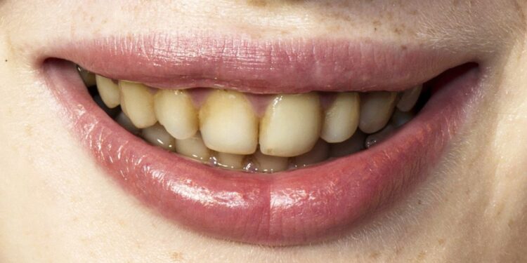 Os vilões da higiene dental: alimentos que escurecem os dentes
