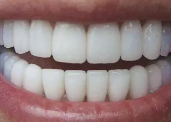 Perder os dentes pode ser um alerta mortal, diz estudo