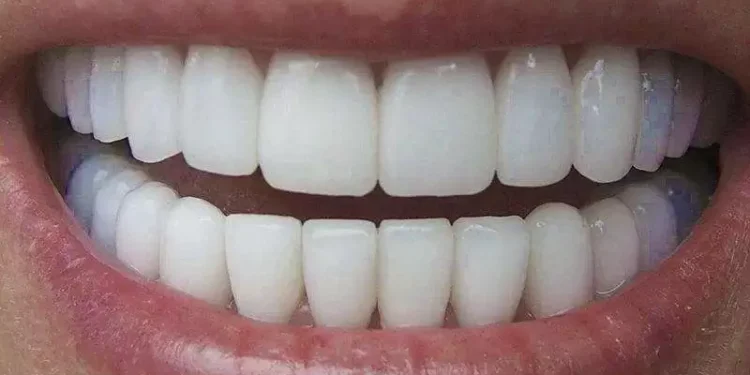 Perder os dentes pode ser um alerta mortal, diz estudo