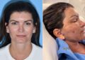 Mulher gastou mais de R$ 410 mil em 6 cirurgias e tomou um susto ao se olhar no espelho e ver o resultado final
