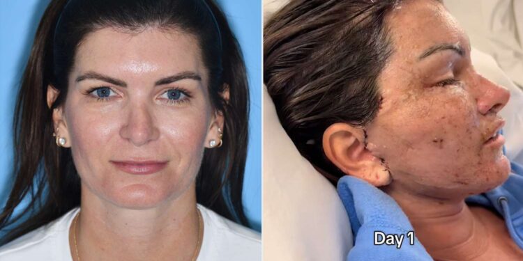 Mulher gastou mais de R$ 410 mil em 6 cirurgias e tomou um susto ao se olhar no espelho e ver o resultado final