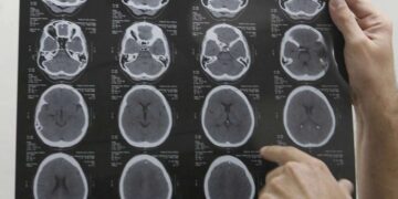 Cientistas chocam o mundo ao revelar que o colesterol pode ser o "herói" do seu cérebro