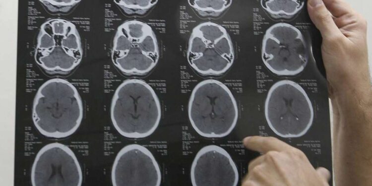 Cientistas chocam o mundo ao revelar que o colesterol pode ser o "herói" do seu cérebro