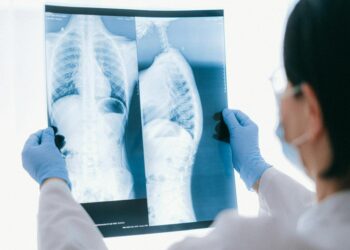 O único estudo que ajuda a detectar precocemente o câncer de pulmão, segundo especialista