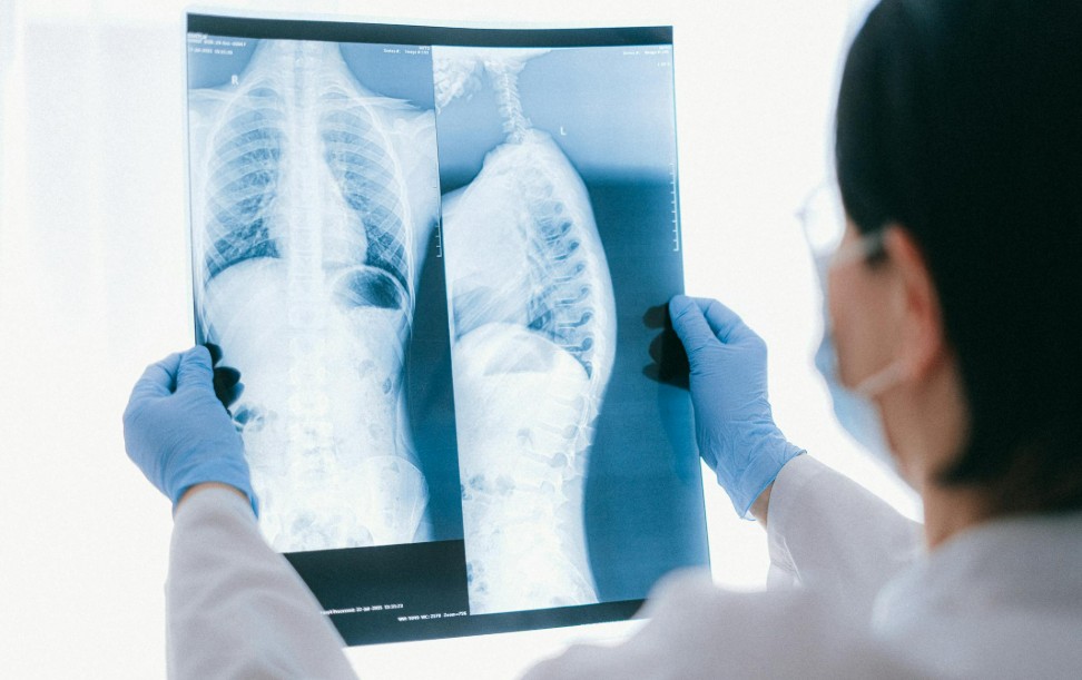 O único estudo que ajuda a detectar precocemente o câncer de pulmão, segundo especialista