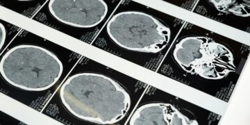 Cientistas diziam ser impossível, mas encontraram um verme capaz de viver no cérebro humano