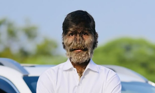 Doença raríssima faz jovem de 19 anos ser chamado de “lobisomem” da vida real