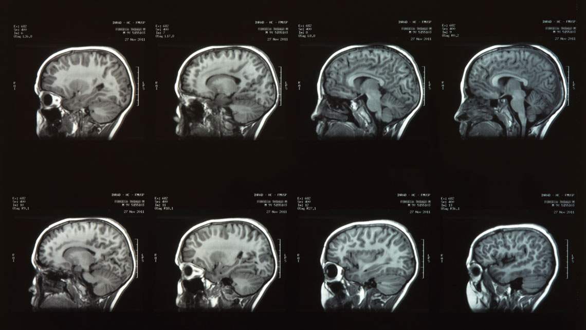 A idade do seu cérebro pode estar adiantada (ou atrasada): veja como descobrir