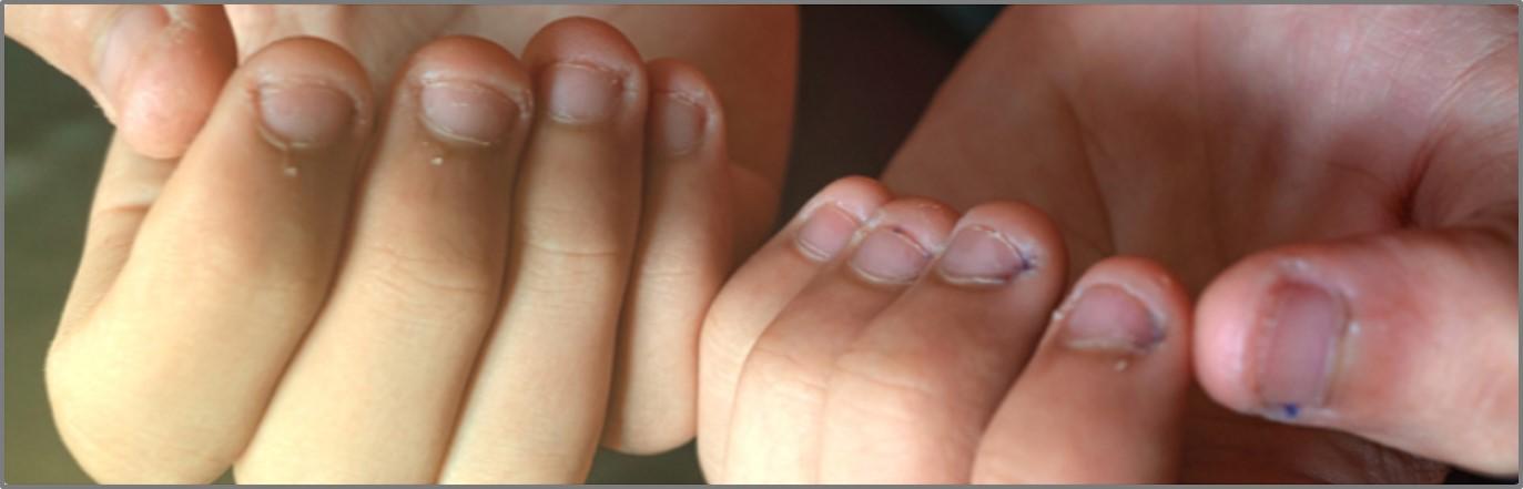 A ciência deu um nome para quem é viciado em roer unhas