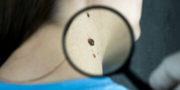 O melanoma, o mais grave câncer de pele, pode surgir de pintas.

Reprodução: Unsplash / Bermix Studio