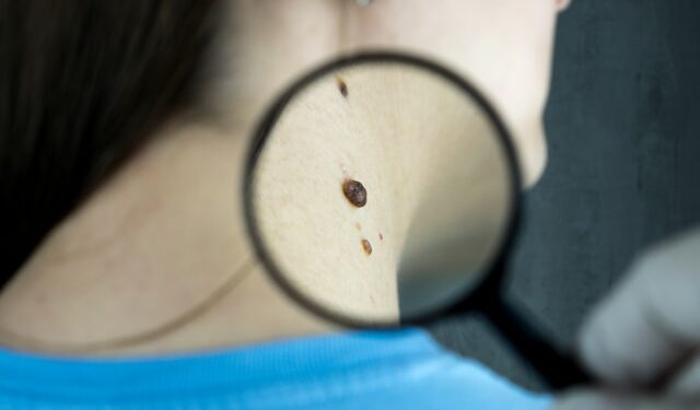 O melanoma, o mais grave câncer de pele, pode surgir de pintas.

Reprodução: Unsplash / Bermix Studio