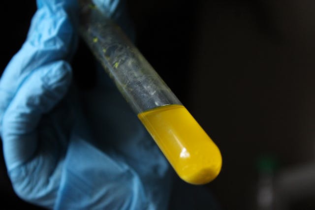 Bolhas na urina pode ser muito mais preocupante do que imagina